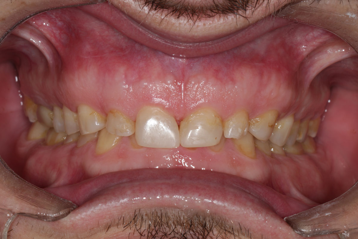 Lentes-de-Contato-Antes