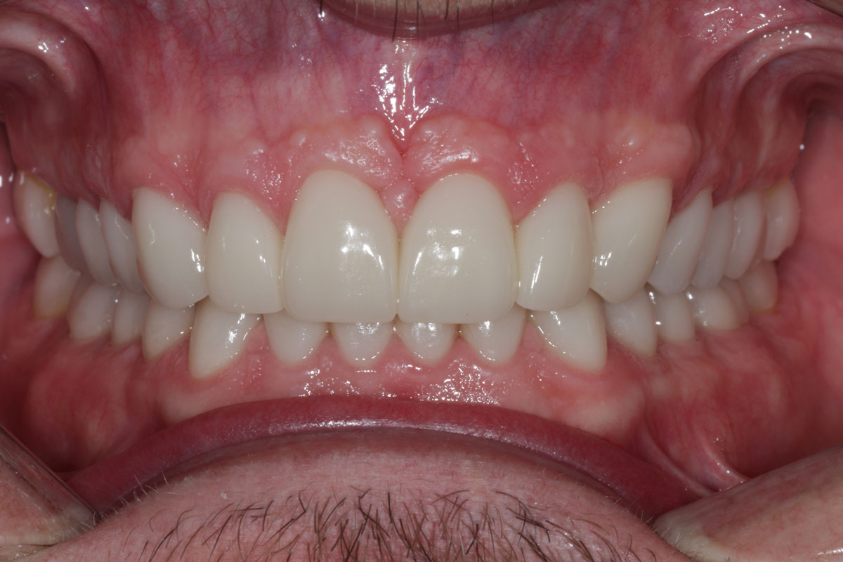 Lentes-de-Contato-CAPA